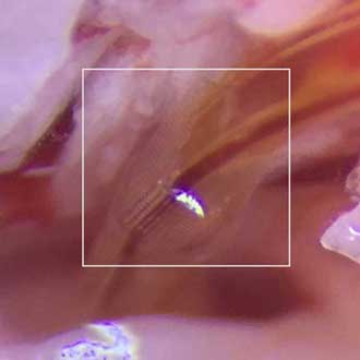 Cochlea Implantat